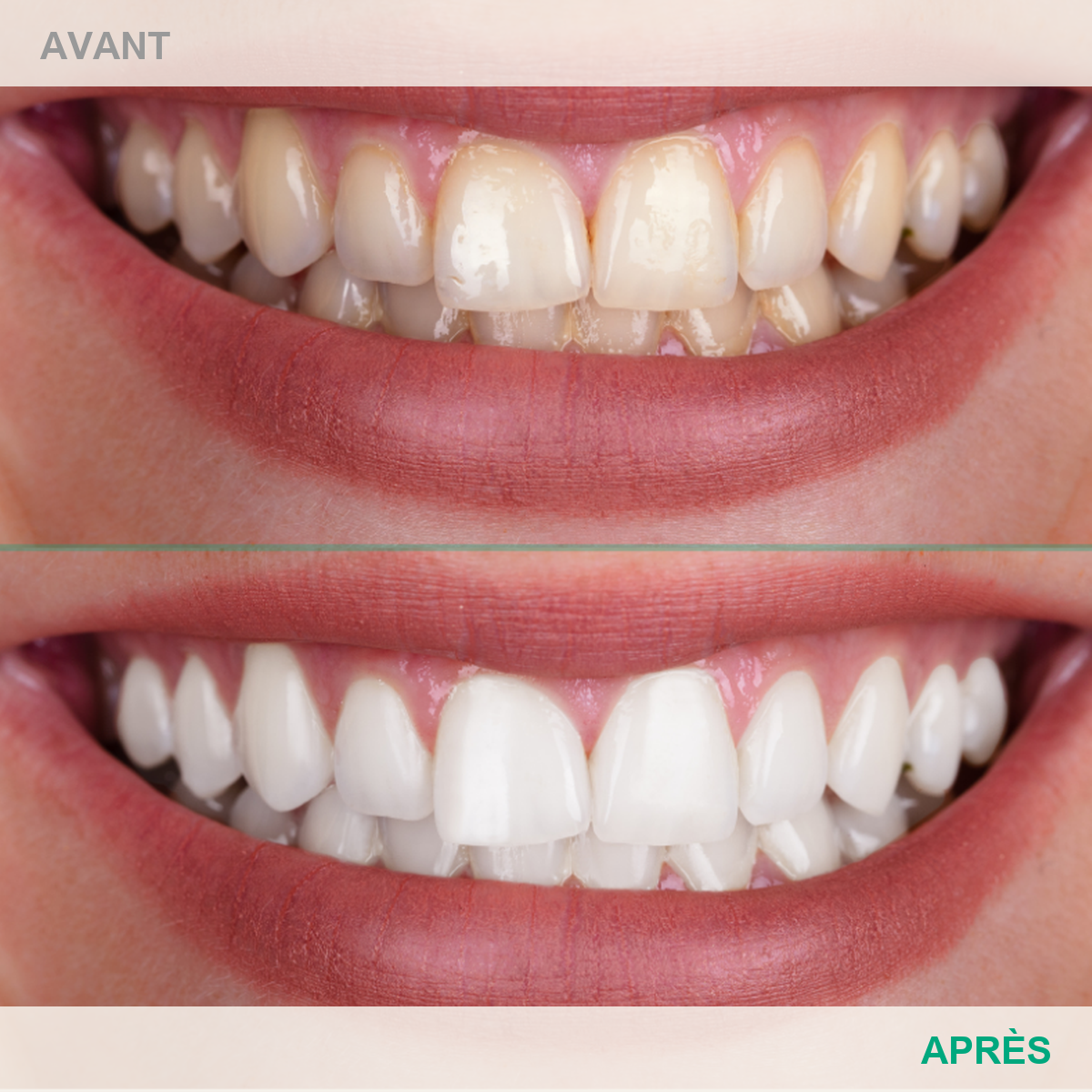 Avant après Le Smile Club - cas 1