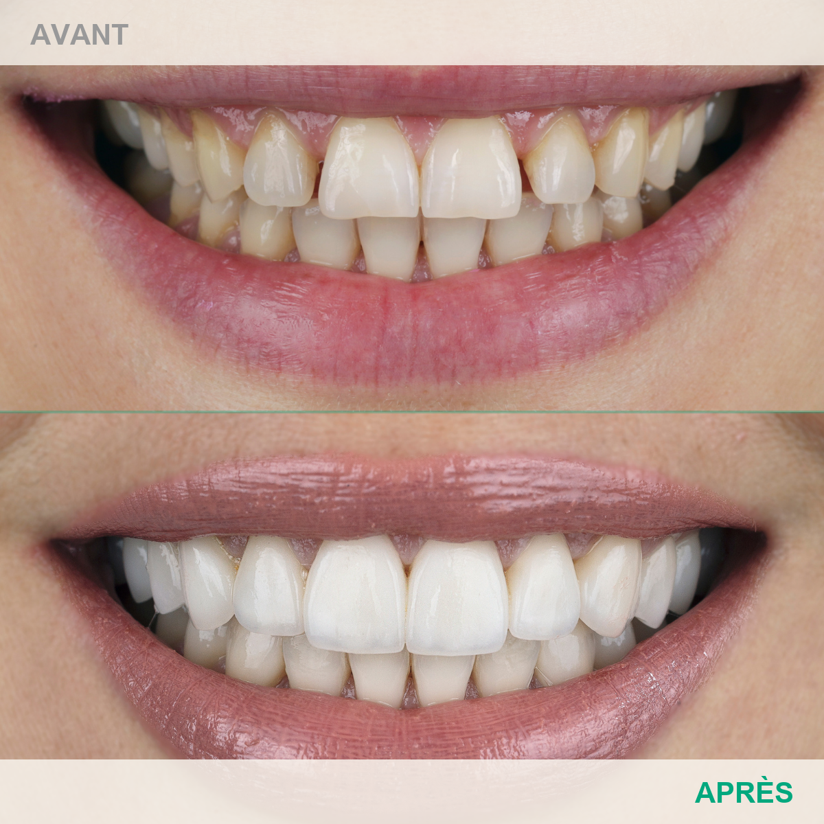 Avant après Le Smile Club - cas 2