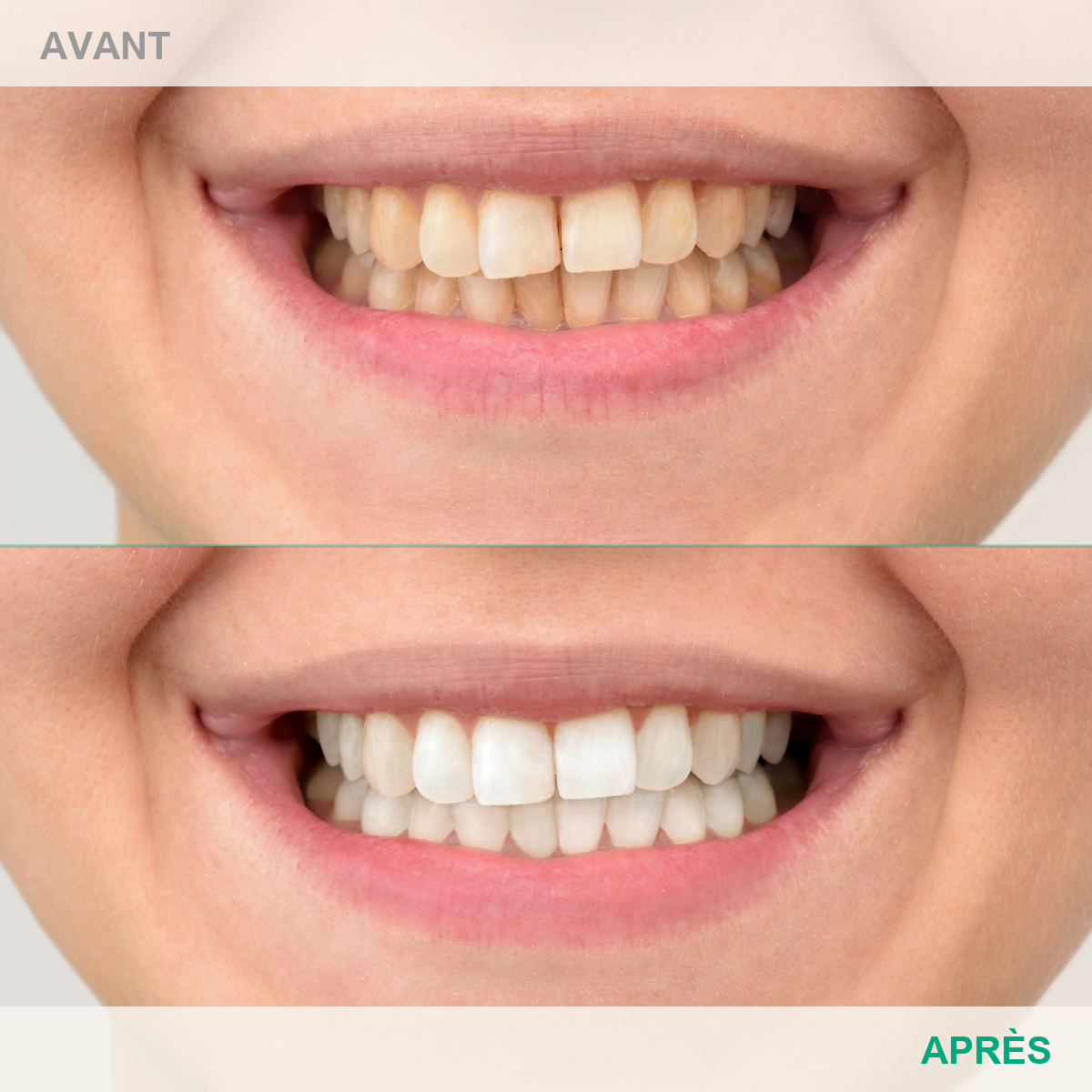 Avant après Le Smile Club - cas 3